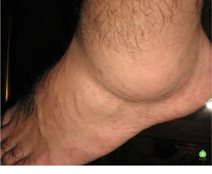 ⚠️ Fini gonflements des jambes et chevilles en 24H